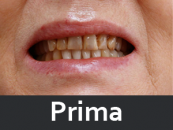 protesi-dentale-prima